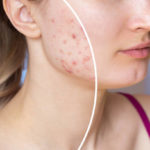Comment fonctionnent les injections de cortisone pour les cicatrices d’acné ?