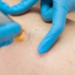 Quels critères permettent de choisir un équipement de Laser endoveineux adapté à sa pratique médicale ?