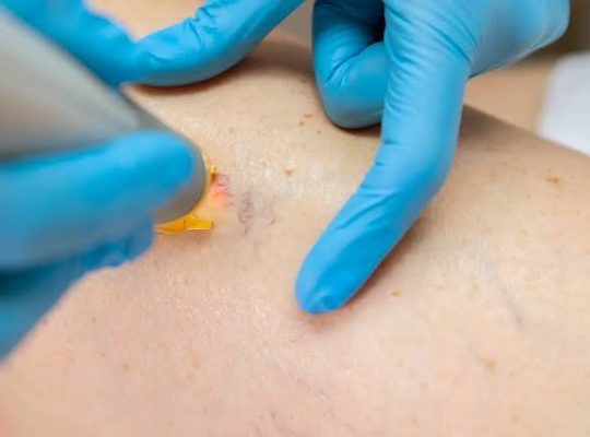 Laser endoveineux