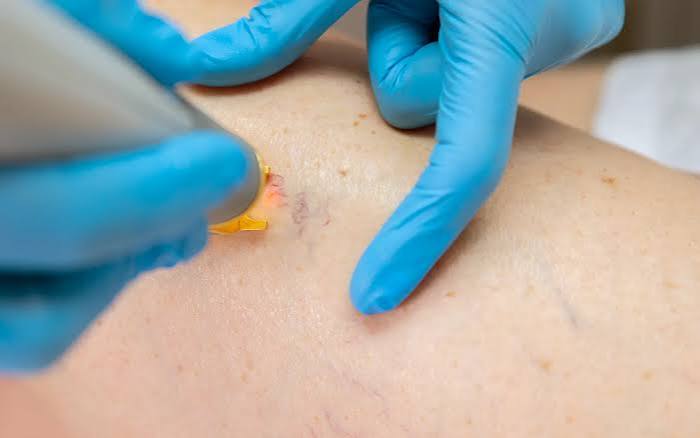 Laser endoveineux